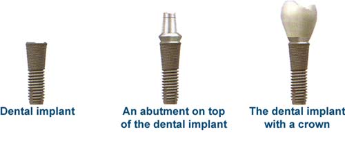 Implants
